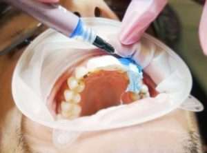 Signs That You May Need Composite Bonding - Essential Dental Care
