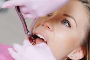 Composite Bonding for Nervous Patients - Essential Dental Care
