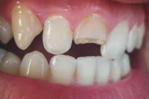 Signs That You May Need Composite Bonding - Essential Dental Care