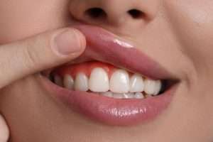 Who Is a Good Candidate for Composite Bonding - Essential Dental Care