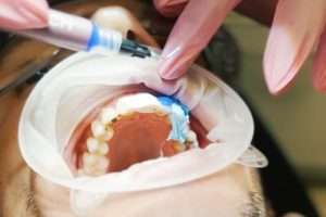 What Is Composite Bonding and Is It Right for You - Essential Dental Care