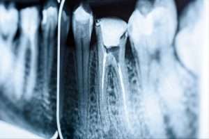 What to Expect from Root Canal at Your Edinburgh Dentist - Essential Dental Care
