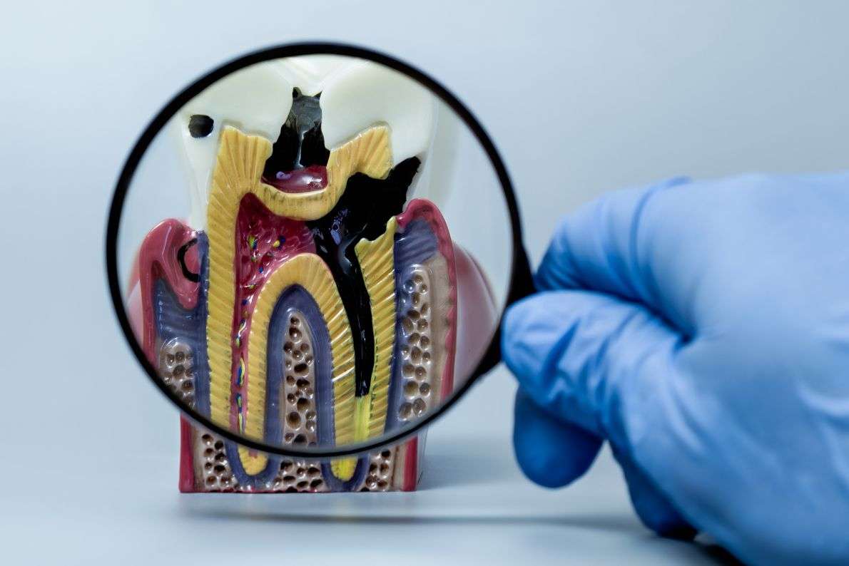 Aftercare Tips Following Your Root Canal Treatment - Essential Dental Care