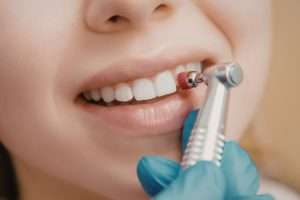 Dental Check-Up vs Professional Clean - Essential Dental Care