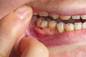 How to Prevent Gum Disease - Essential Dental Care