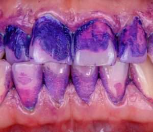What is EMS Airflow Guided Biofilm Therapy - Essential Dental Care