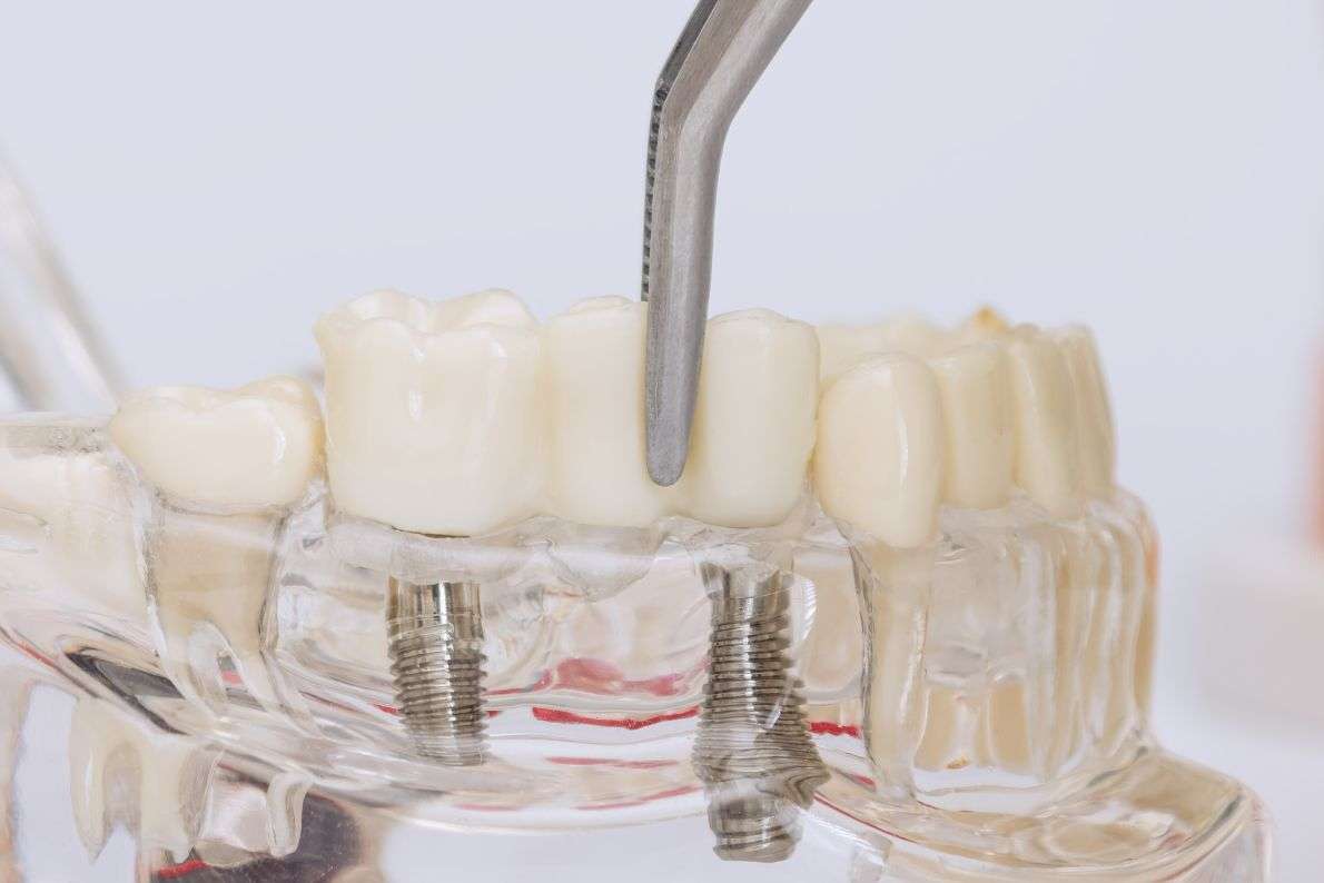 What Is a Dental Bridge and Is It Right for You?