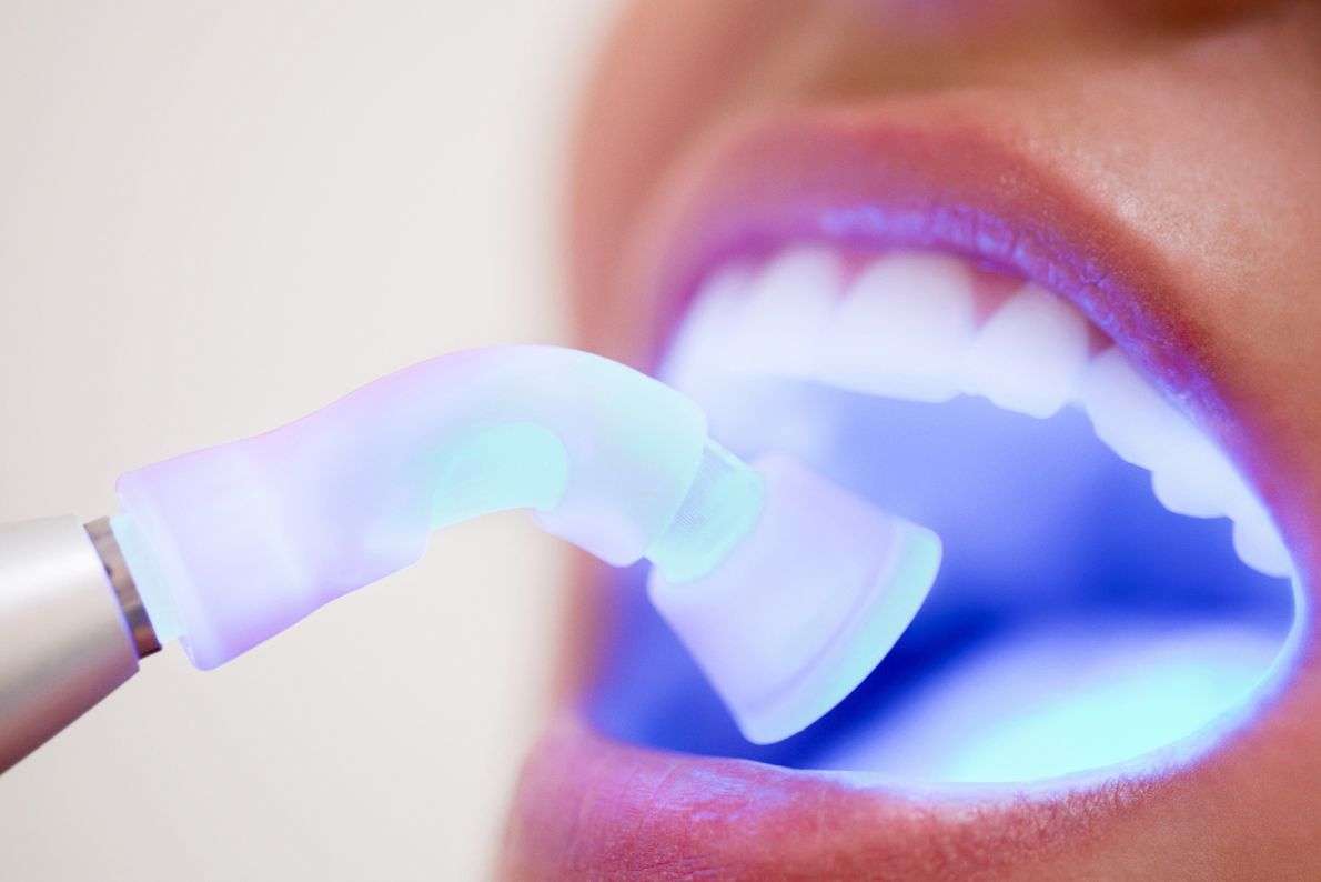 What to Expect from Composite Bonding at Your Edinburgh Dentist