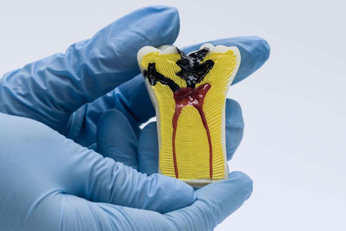 What to Expect from Root Canal at Your Edinburgh Dentist